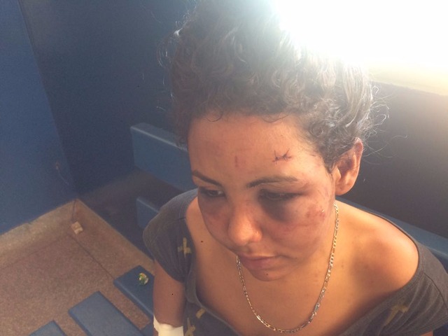 Ataque à estudante de 19 anos pode ser um ato de retaliação J.S.P de 19 anos, com diversas lesões no rosto. Foto. Rone Cezar Leal