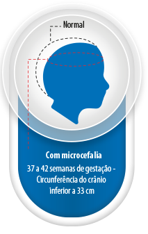 Microcefalia