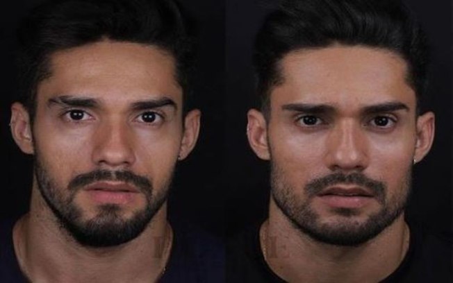 Saiba tudo sobre a harmonização facial, procedimento feito por Arcrebiano, do BBB21 Saiba tudo sobre a harmonização facial, procedimento feito por Arcrebiano, do BBB21