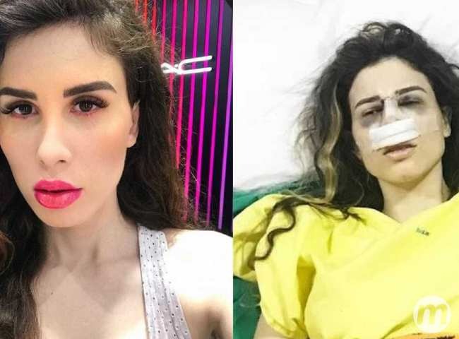Youtuber brasileira fica sem andar após infecção em prótese de silicone Camila Uckers: corpo rejeitou próteses nas nádegas (Reprodução)