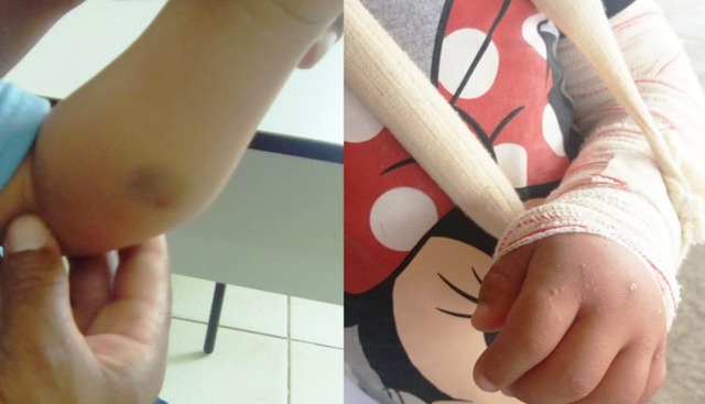 Aluna com síndrome de down quebra braço na escola e ninguém nota Aluna com síndrome de down quebra braço na escola e ninguém nota