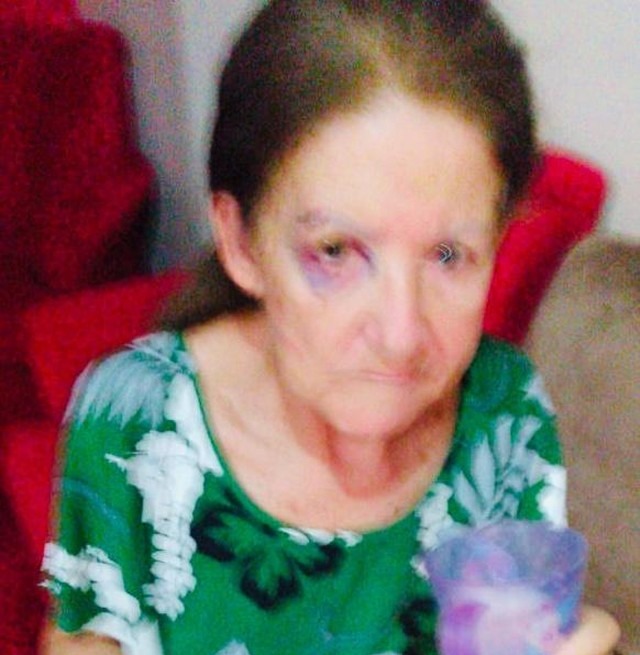 Idosa fica com olho roxo ao ser ferida pelo neto de criação em MS: 'Apanhou no dia do aniversário de 69 anos'