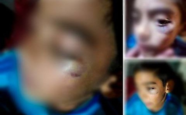 Mãe reclama de escola pública após filho de 9 anos voltar para casa com olho roxo Mãe reclama de escola pública após filho de 9 anos voltar para casa com olho roxo