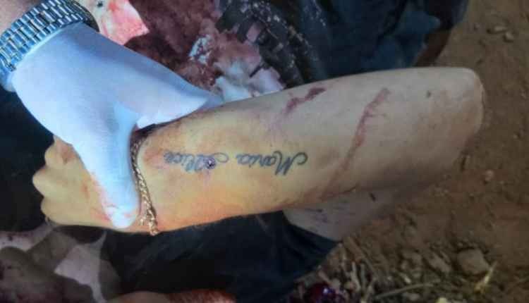 Braço foi quebrado por suspeitos (Foto: Porã News)