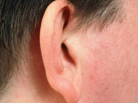 Nova técnica usa gordura para 'cultivar' orelhas Método pode ser forma menos agressiva de corrigir malformação congênita (Foto: BBC)